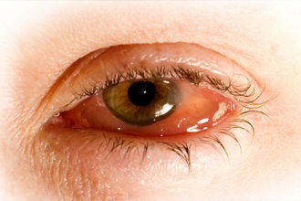 Conjuntivitis