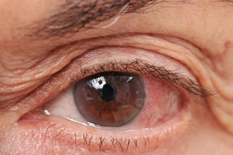 Desprendimiento de Retina