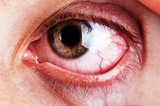 Glaucoma