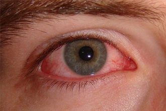 Ojo Seco
