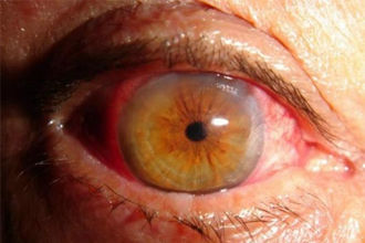 Retinopatía Diabética